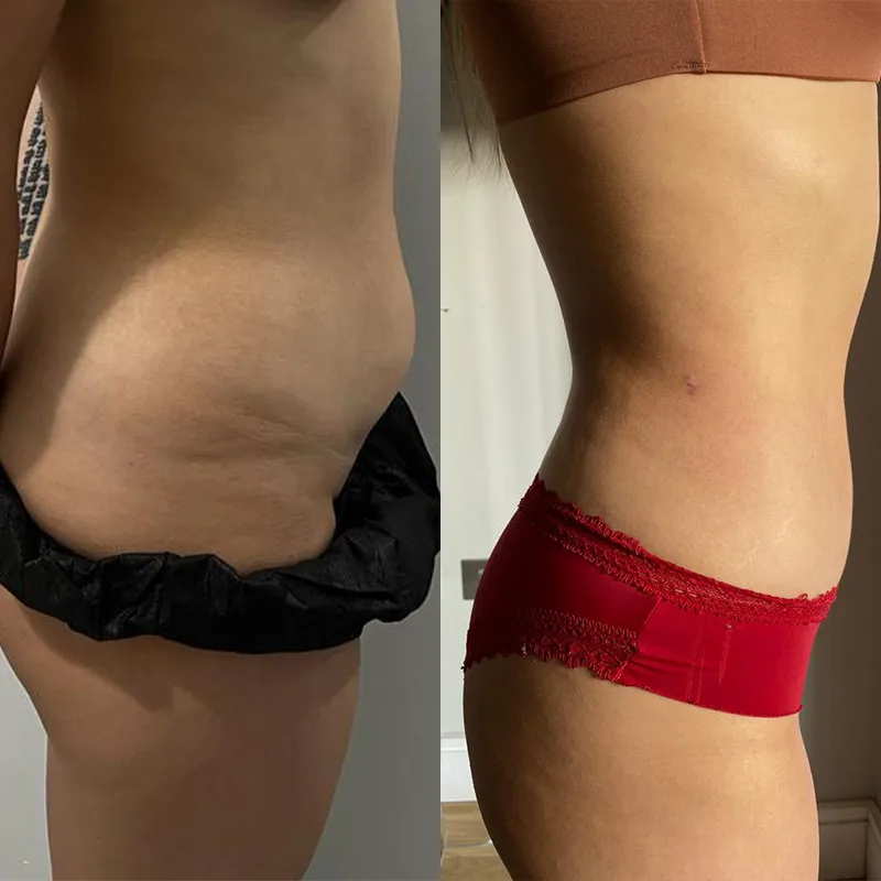 Vaser lipo before and after