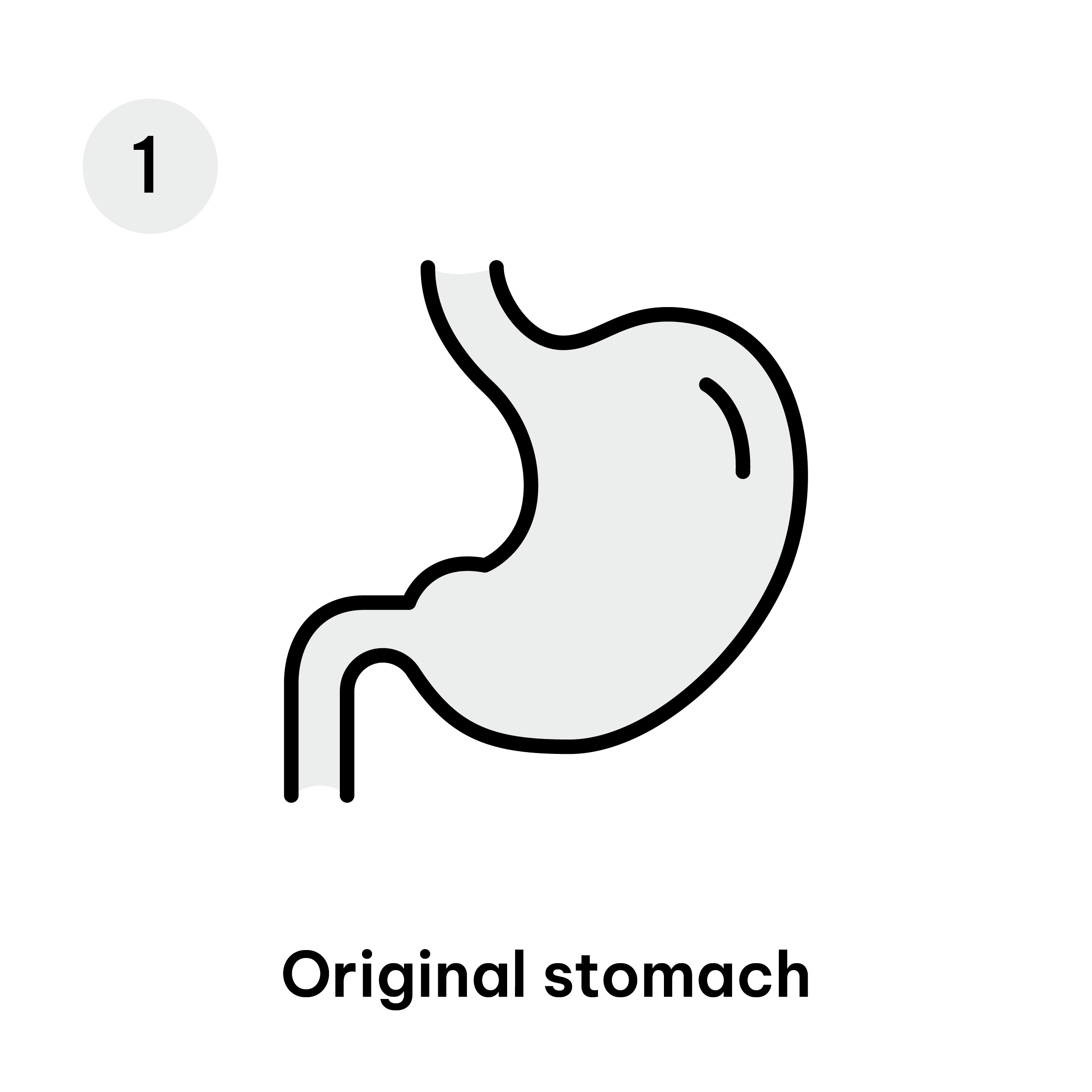 Gastric Sleeve Diagram-03