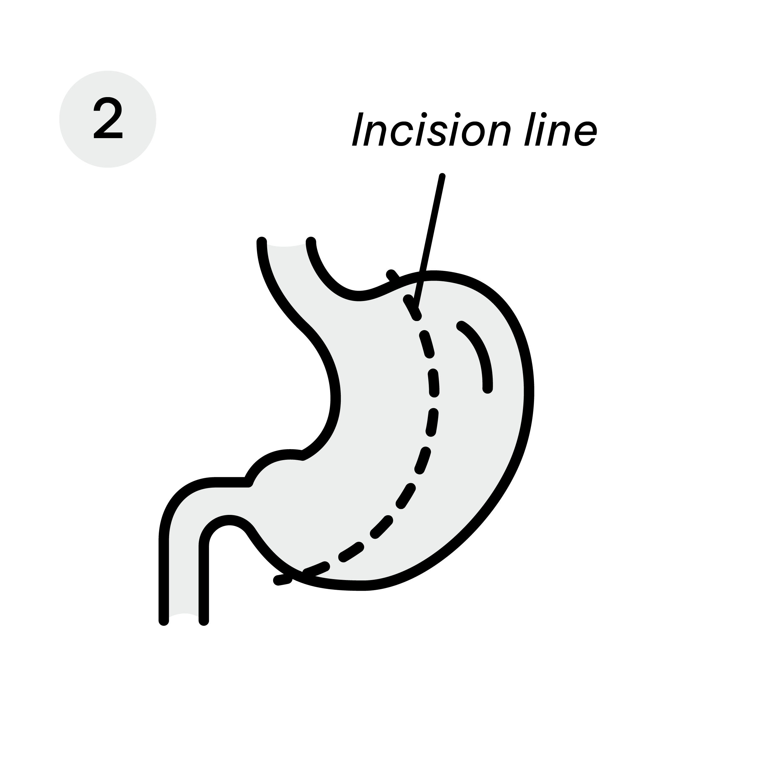 Gastric Sleeve Diagram-04