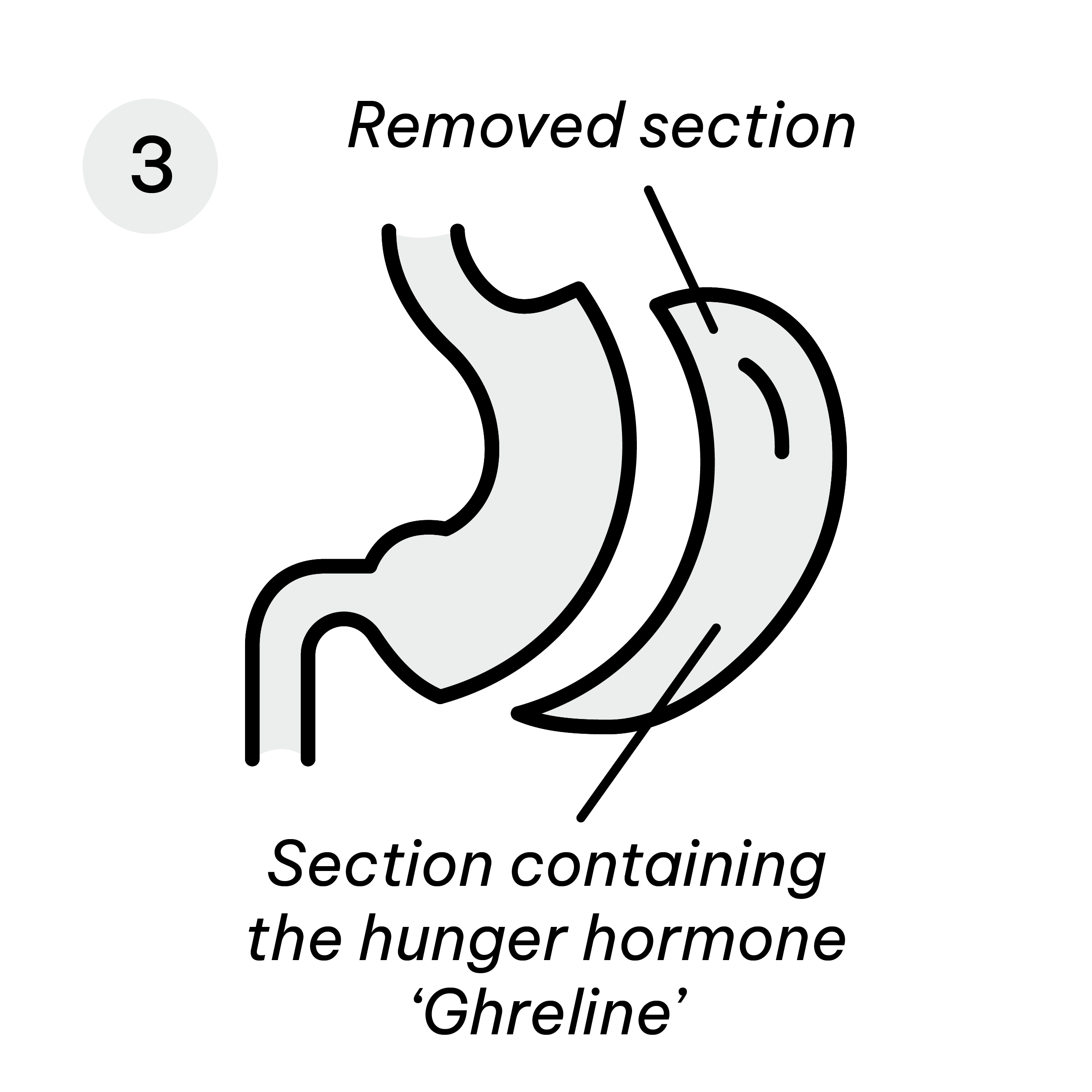 Gastric Sleeve Diagram-05