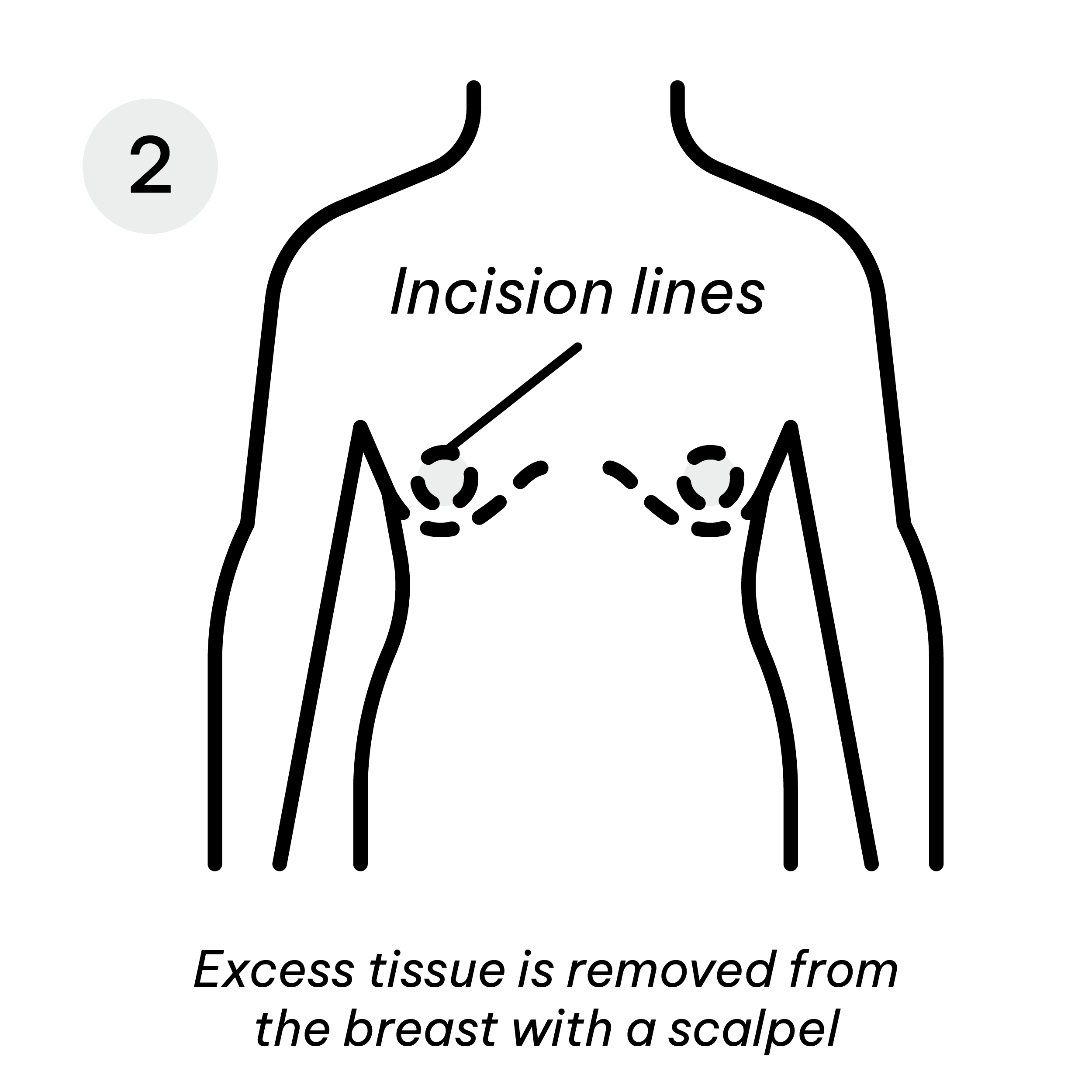 Gynaecomastia Incision Lines