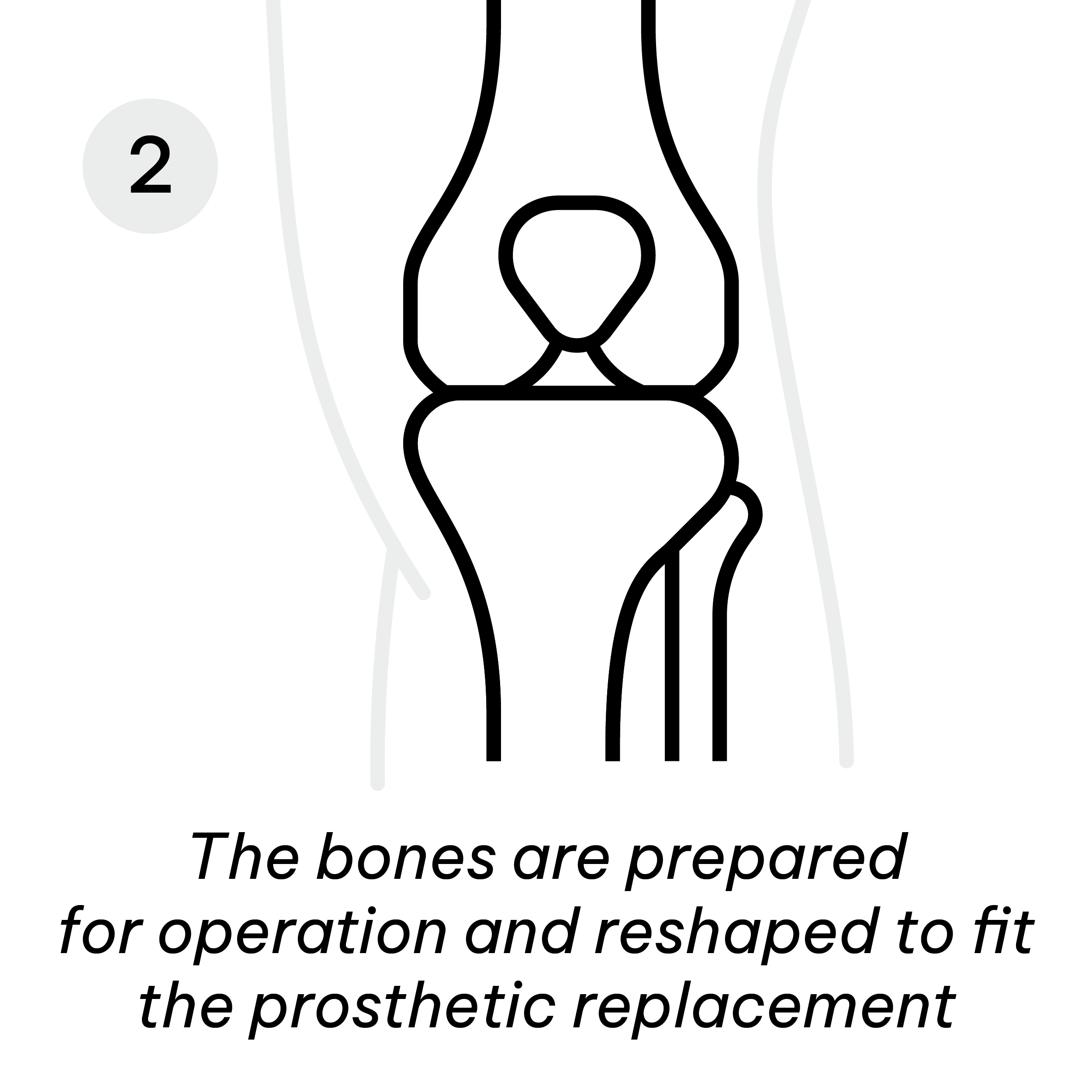 knee preparing for surgery