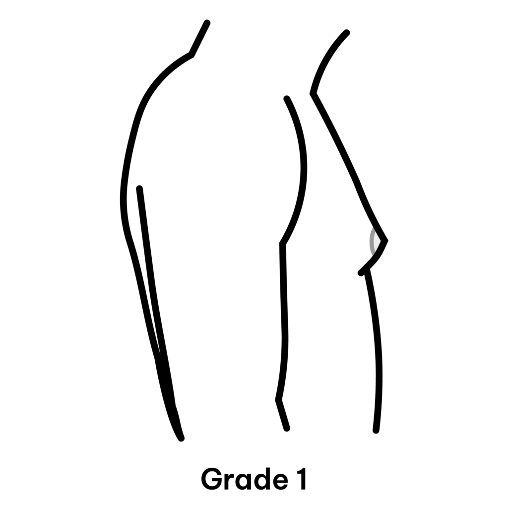 Gynaecomastia Grade 1