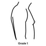 Gynaecomastia Grade 1