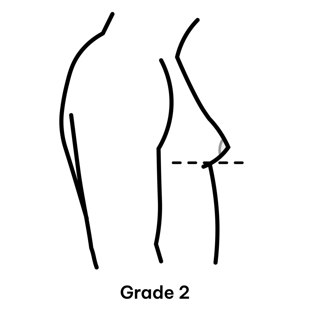 Gynaecomastia Grade 2