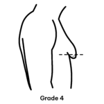 Gastric Diagrams_Gynaecomastia Grades 5