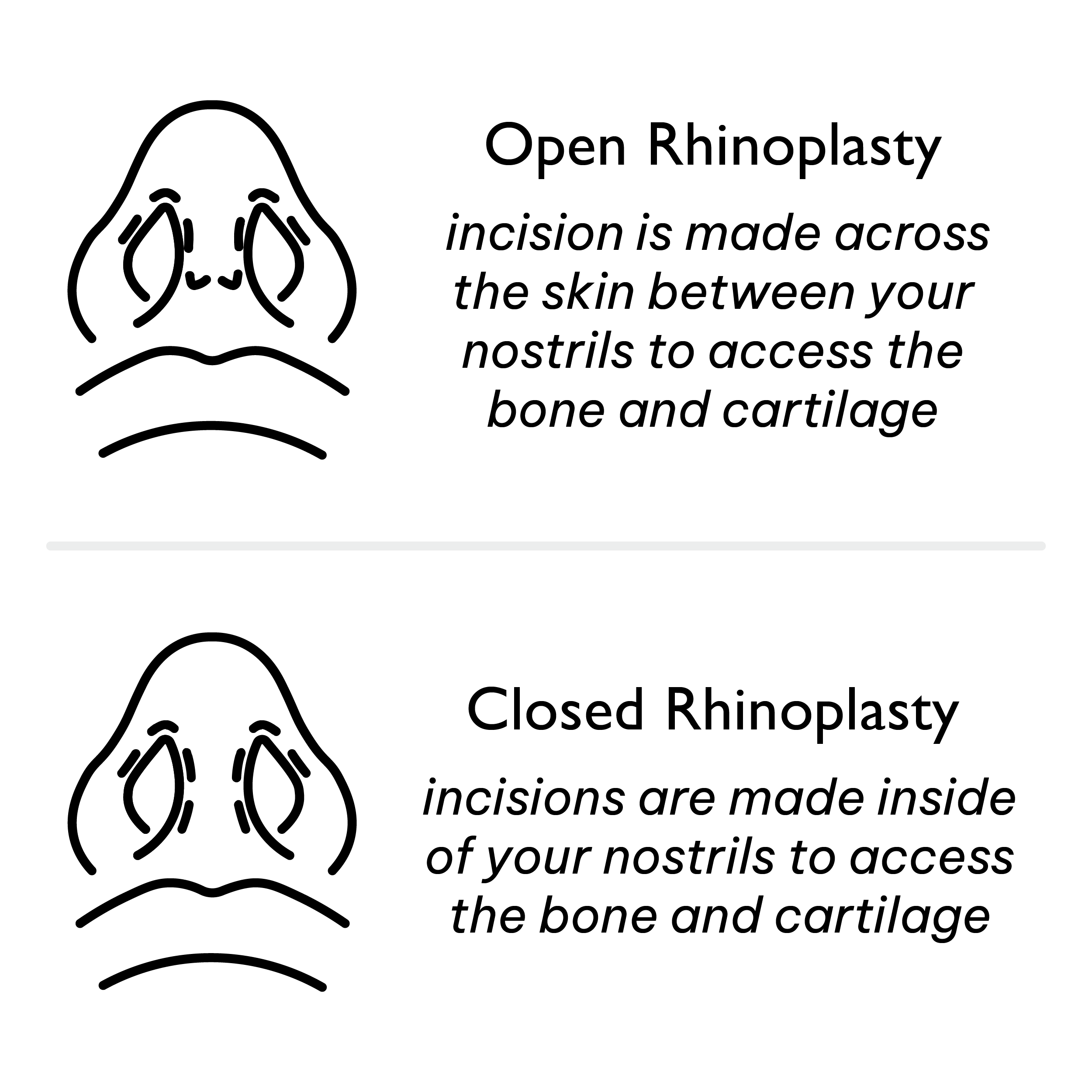 Open Vs Closed Rhinoplasty