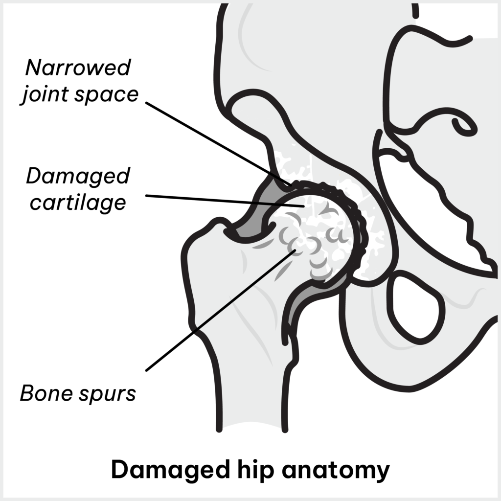 Damaged Hip