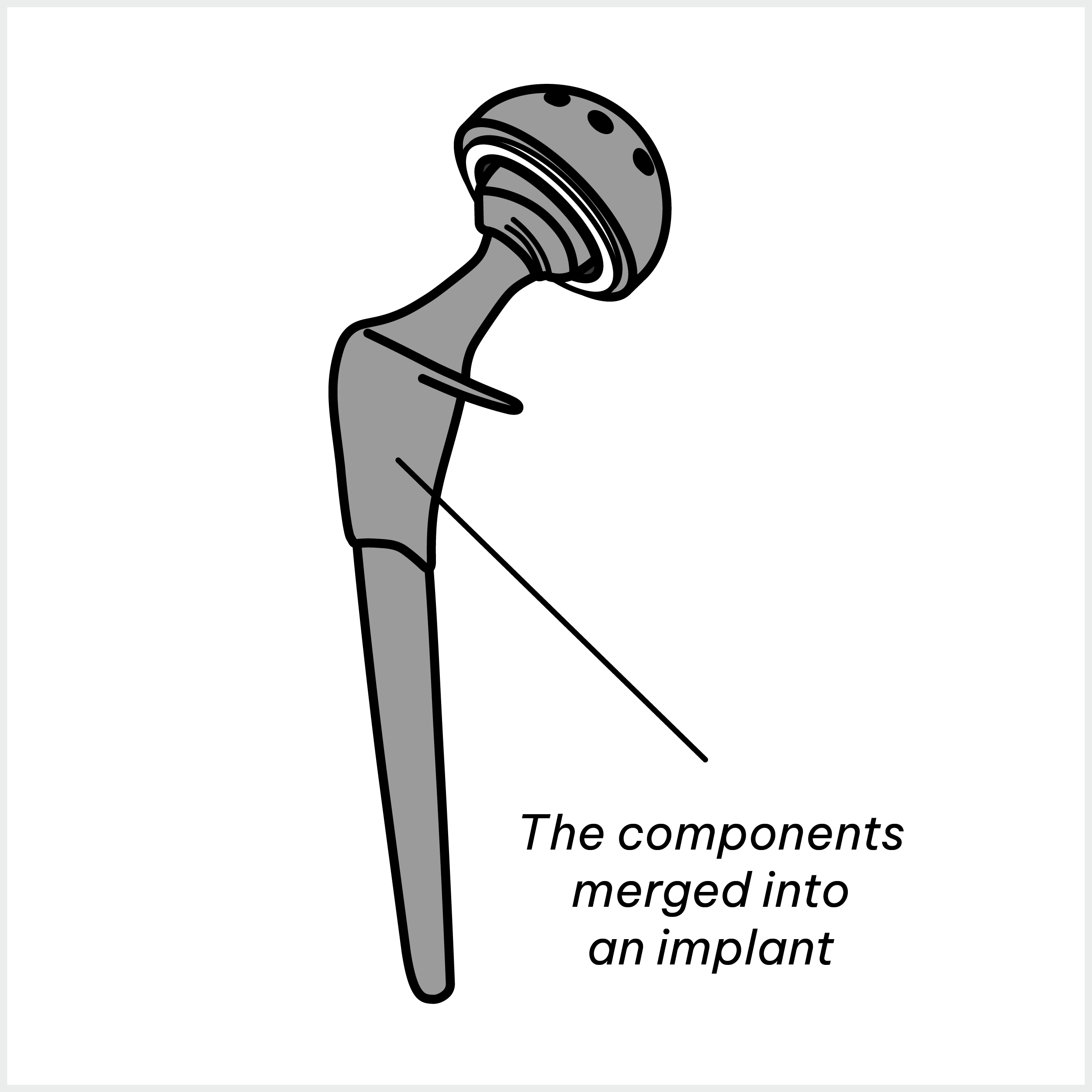 Hip implant 2