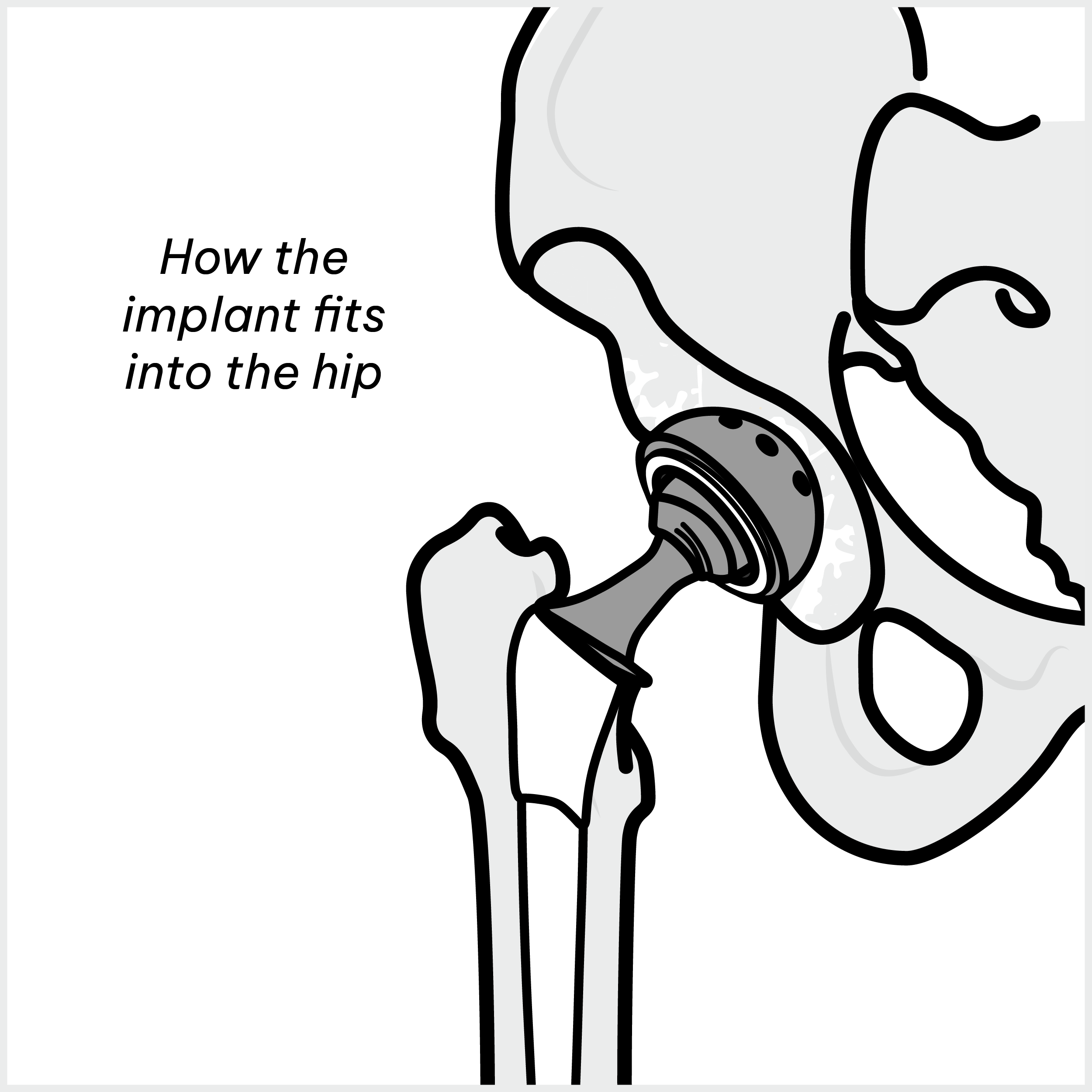 Hip Implant 3