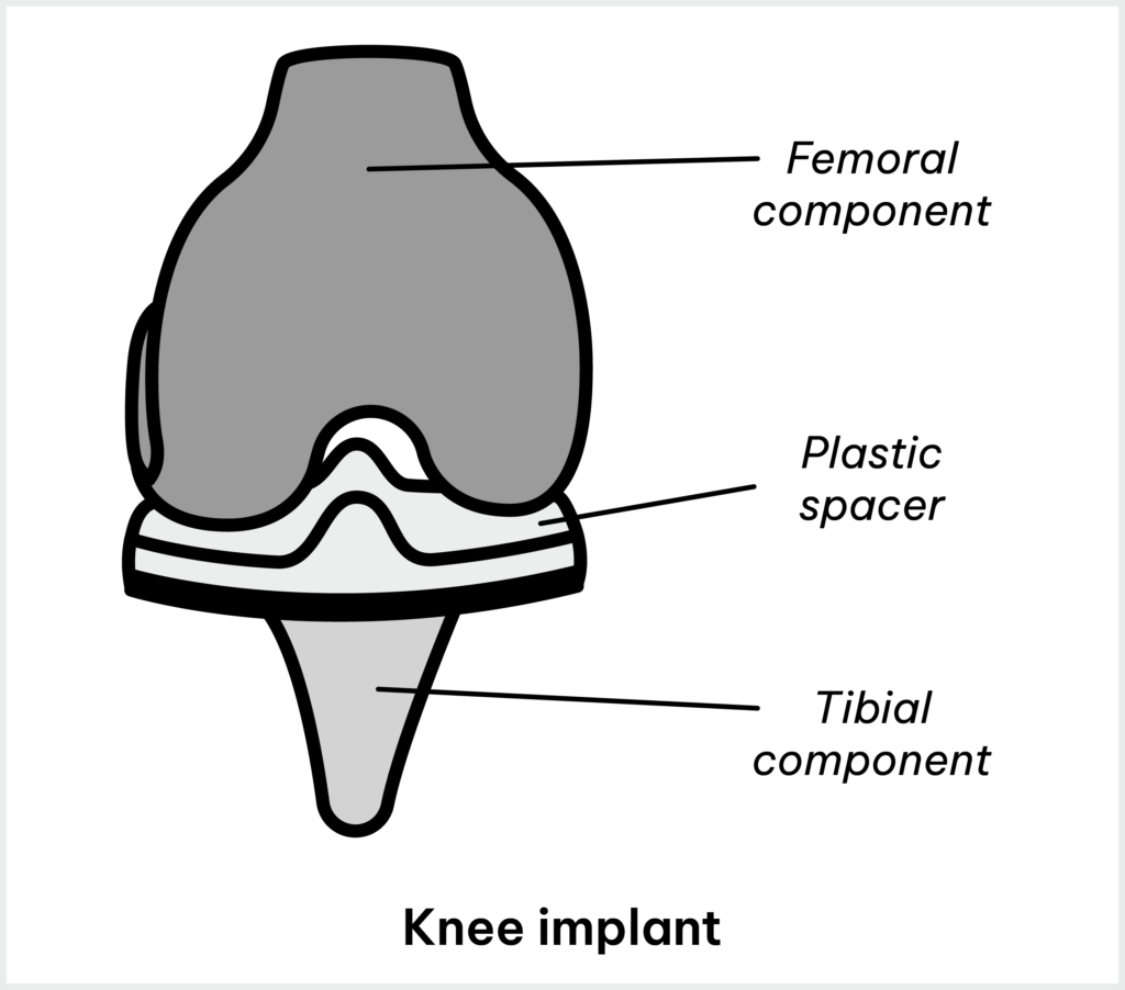 Knee Implant